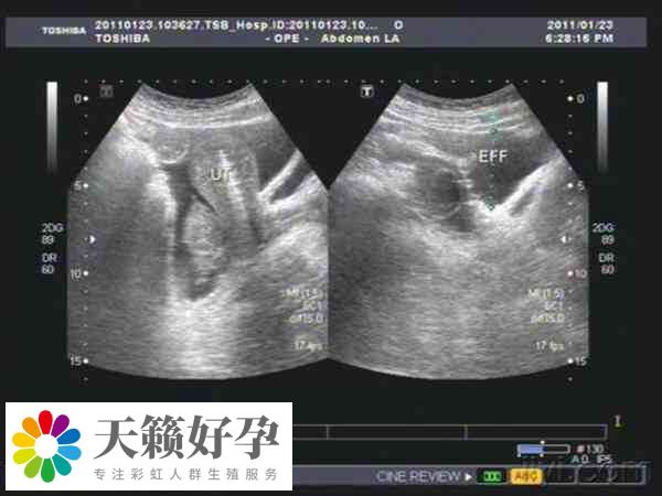 28個(gè)卵泡做試管成功率高不高