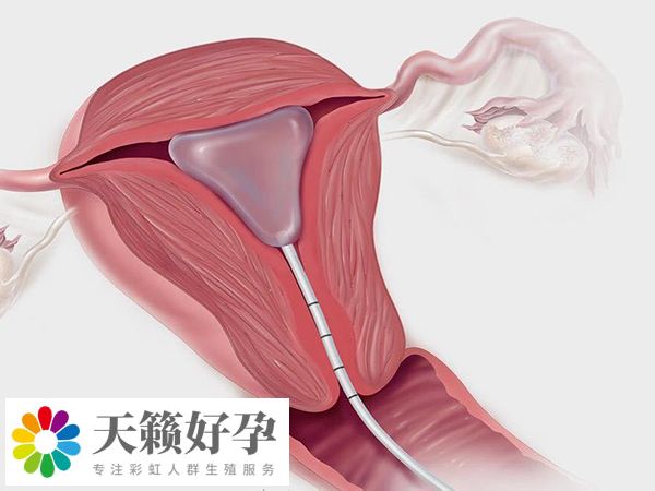 宮內(nèi)探查能發(fā)現(xiàn)宮腔粘連