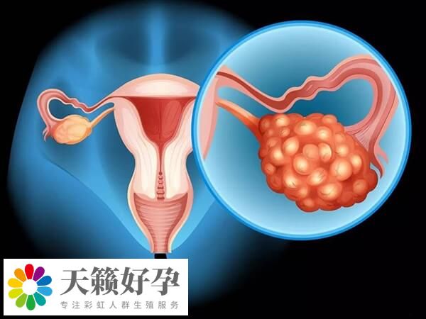 有卵巢刺激綜合征不能移植鮮胚