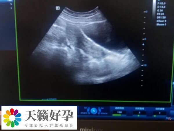 哪些情況下會(huì)取消鮮胚移植看這，孕酮升高的別盲目移